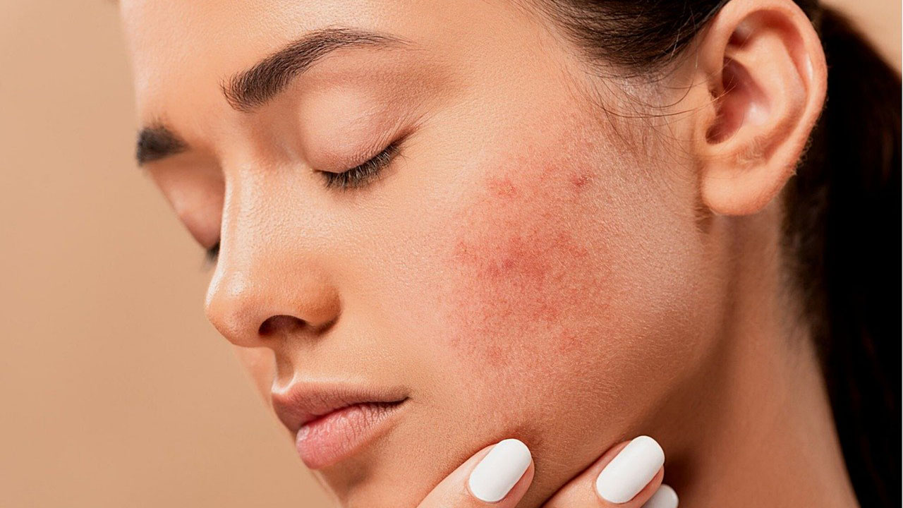 Home Remedies for Acne Scars