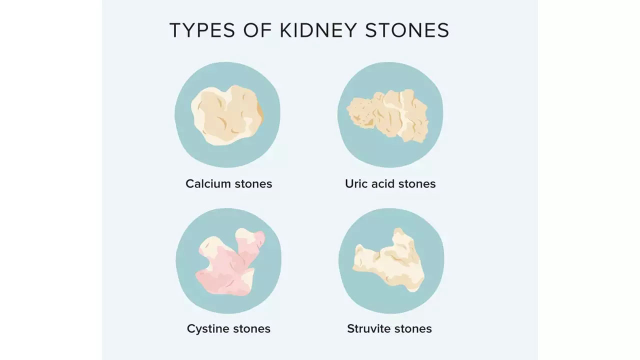 Types Of Kidney Stones