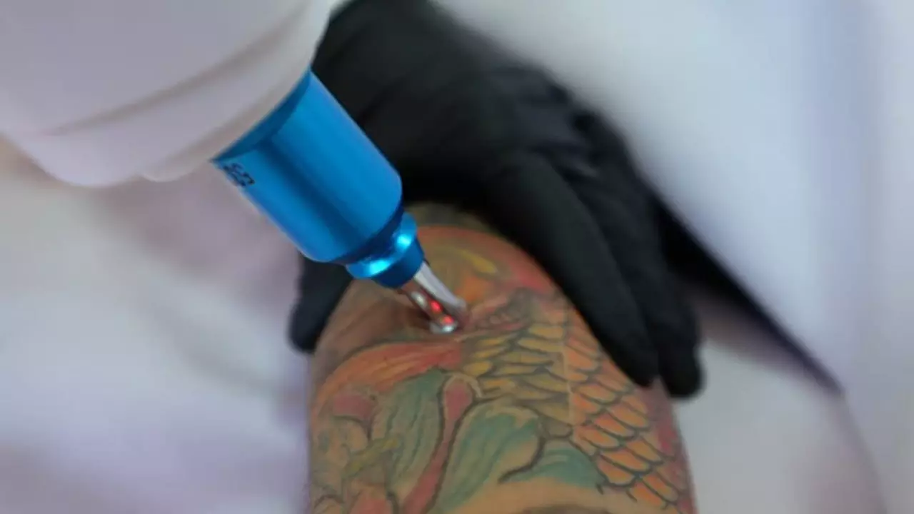 Tattoo Laser Removal