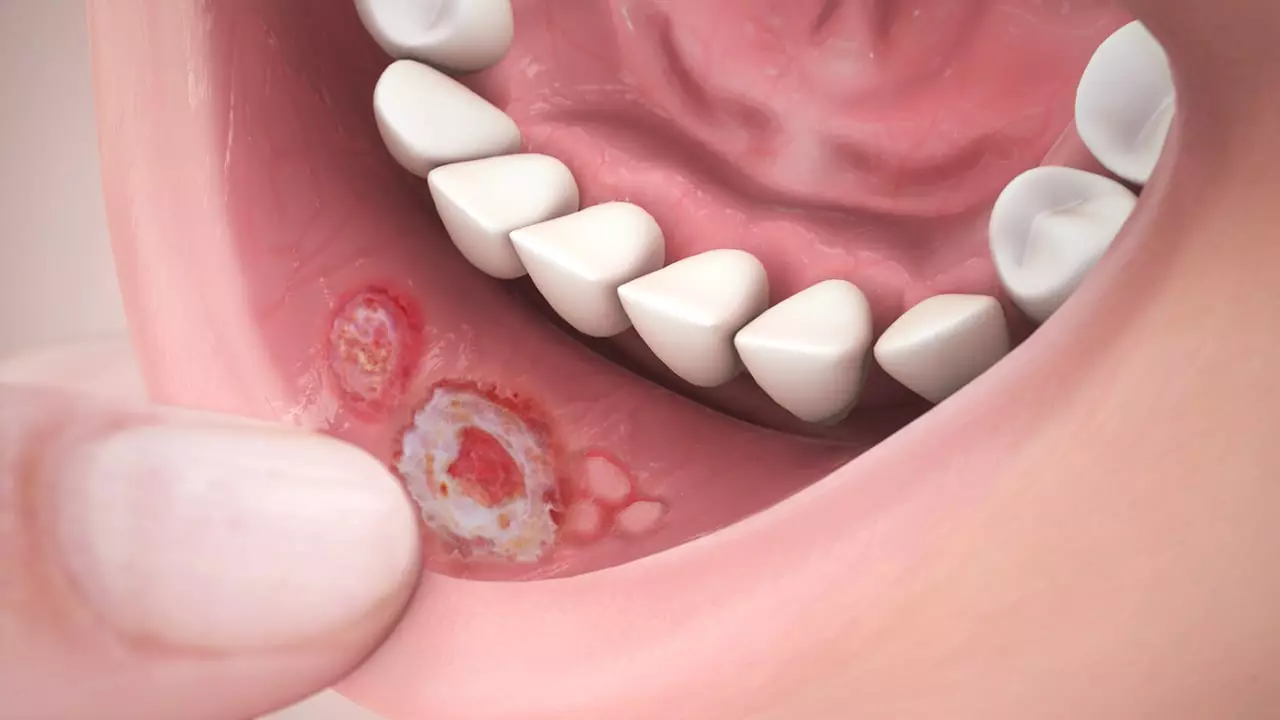 Causes of mouth ulcers according to Ayurveda