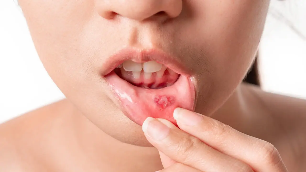 Tips to prevent mouth ulcers