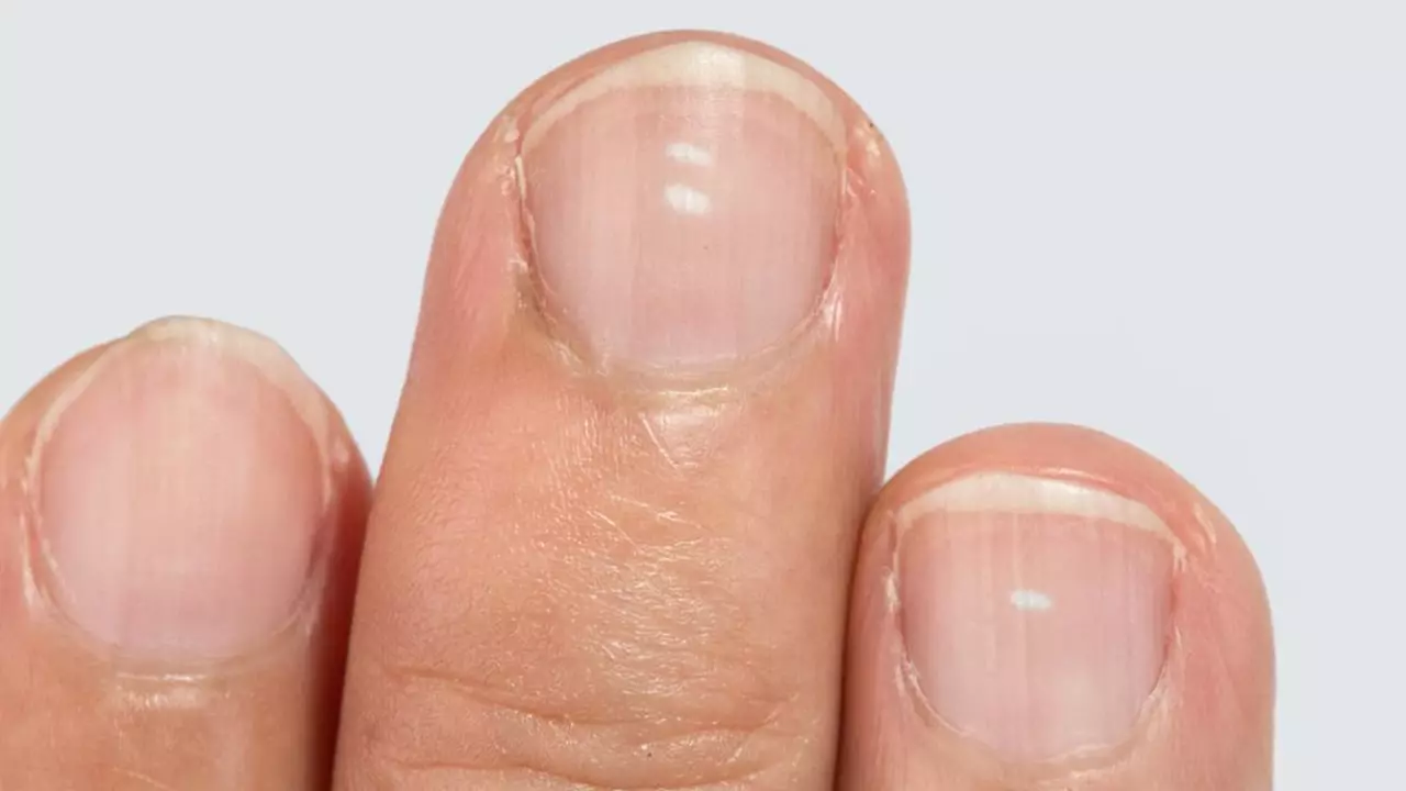 Illustration of white spots on fingernails