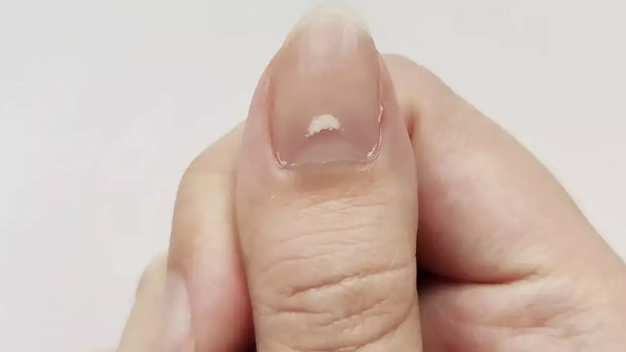 Illustration showing potential causes of white spots on nails