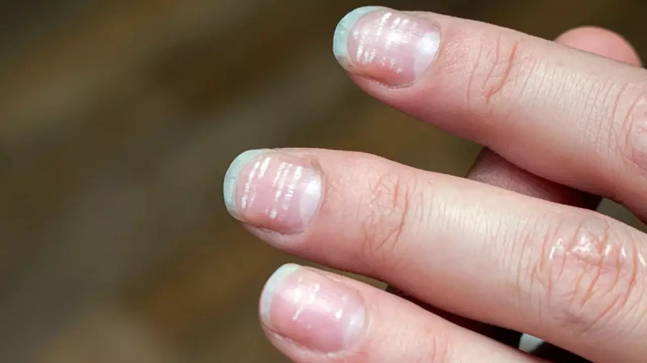 Illustration depicting the link between white spots on nails and underlying health conditions.