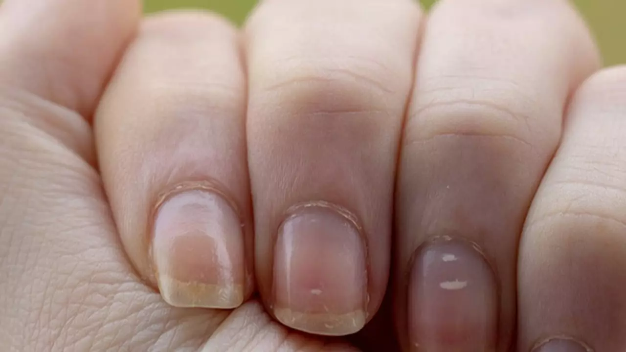 Illustration showing when to consult a doctor about white spots on nails.