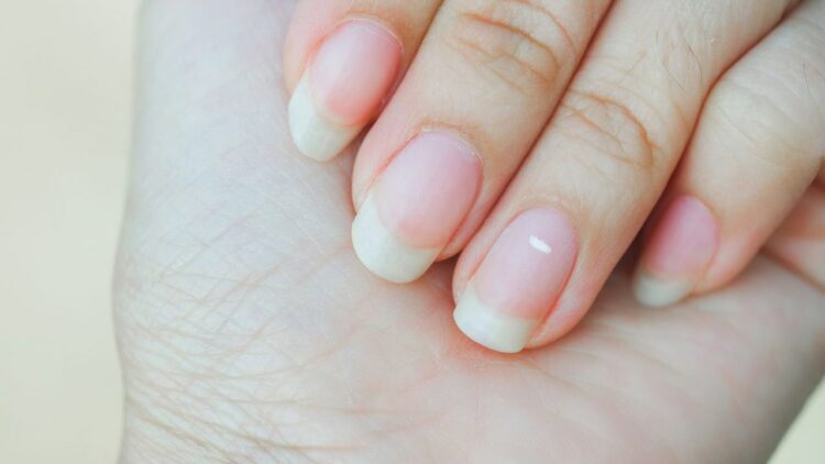 White Spots on Nails