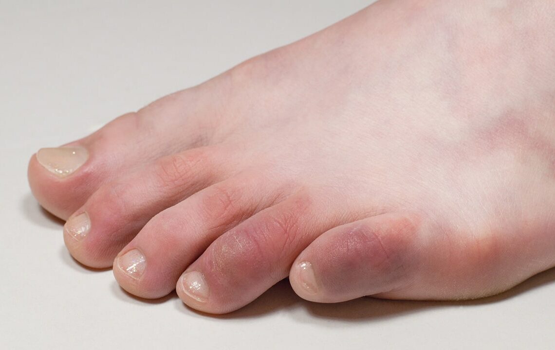 Sturdy Lifestyle Home Remedies for Swollen Toes