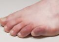 home remedy for swollen toe finger