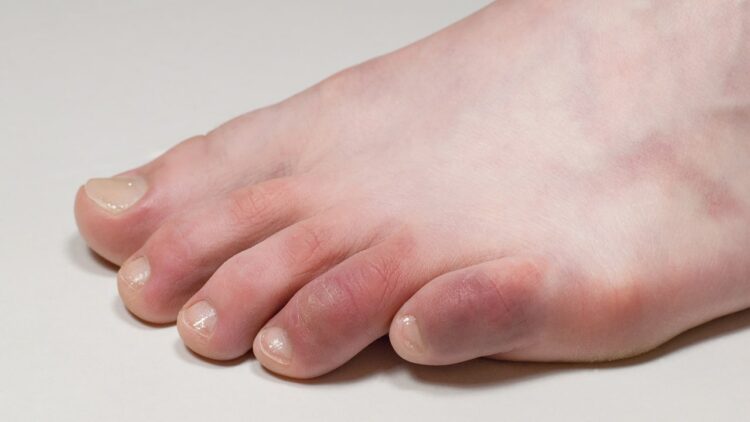home remedy for swollen toe finger