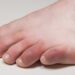 home remedy for swollen toe finger