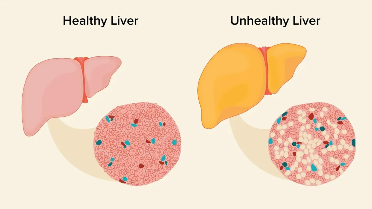 Ayurvedic Home Remedies for Fatty Liver