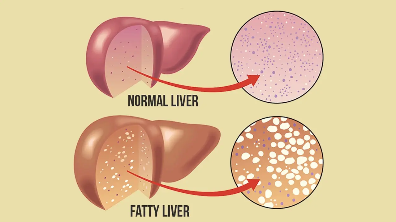 how to reduce fatty liver quickly