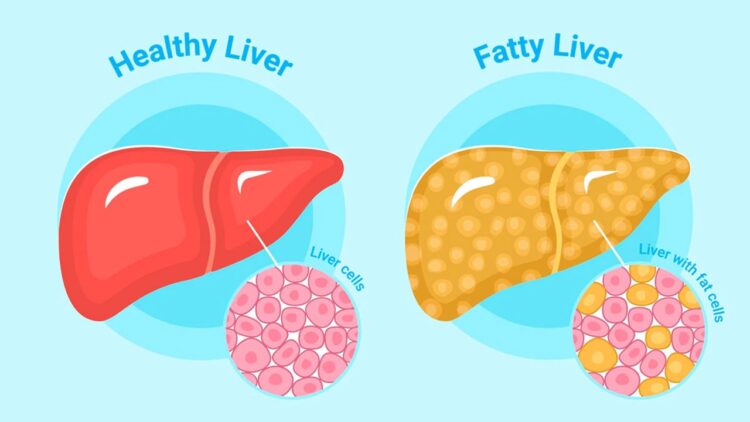 Ayurvedic Home Remedies for Fatty Liver