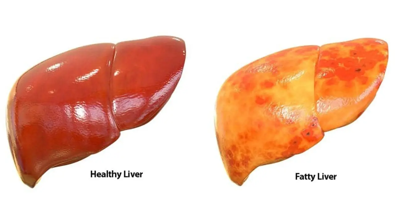 foods to avoid with fatty liver