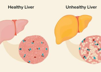 Fatty Liver Diet