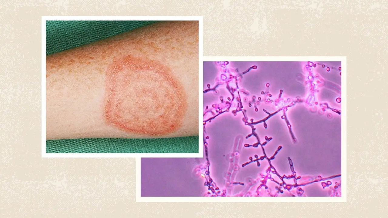 home remedies for ringworm on arm