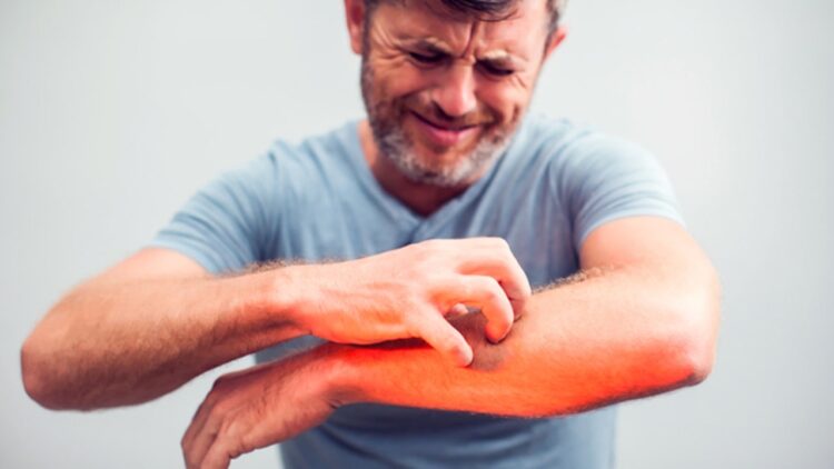How to get rid of heat rash quickly