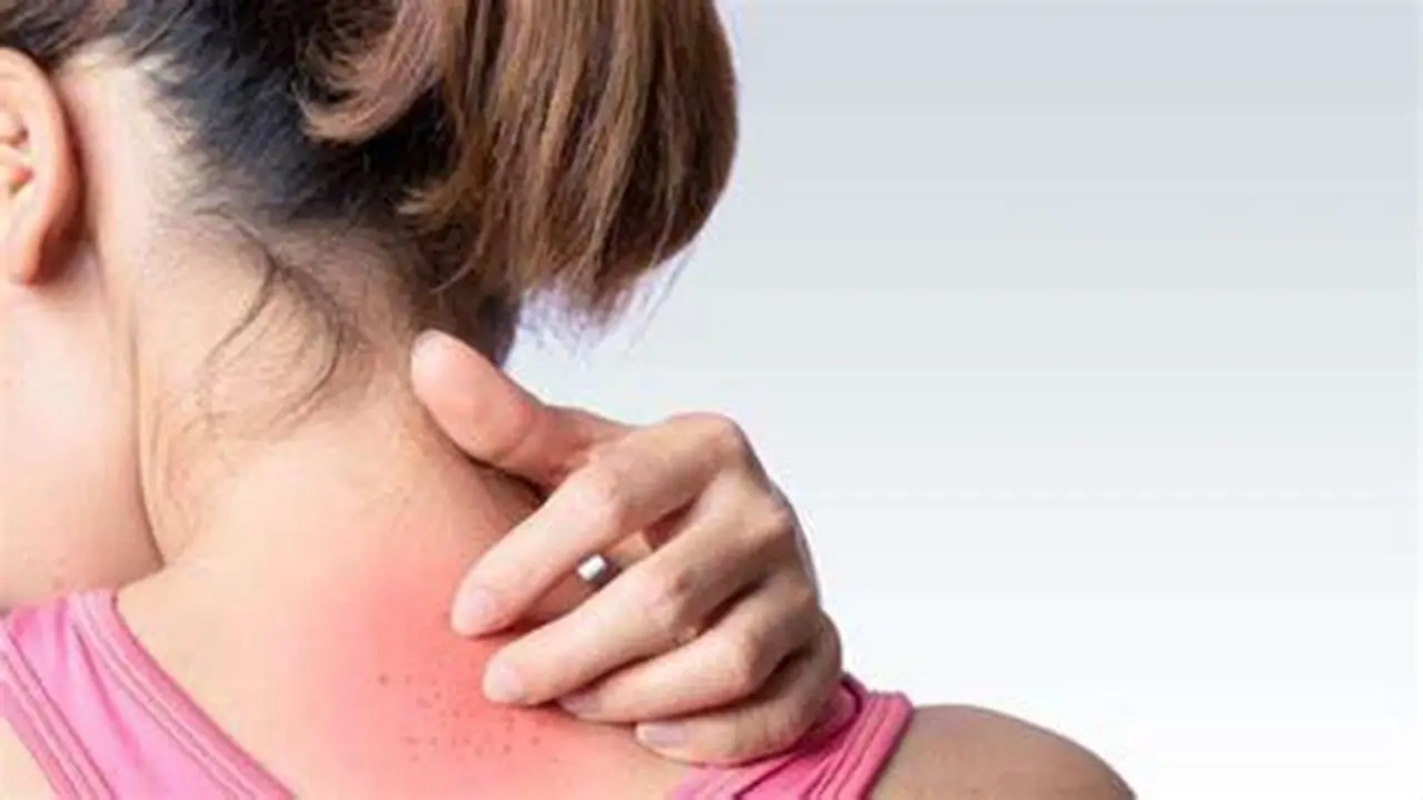 Allergic reaction heat rash baby