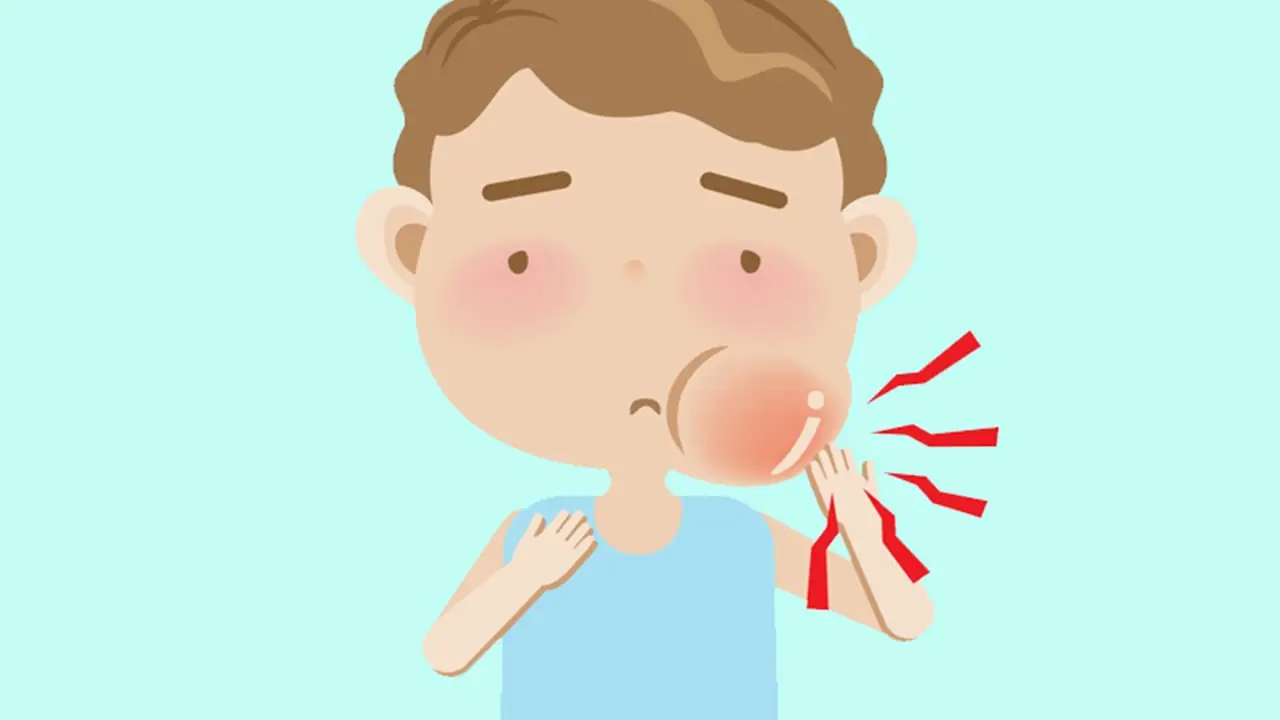 mumps symptoms