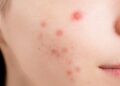 how to get rid of pimples overnight