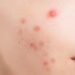 how to get rid of pimples overnight